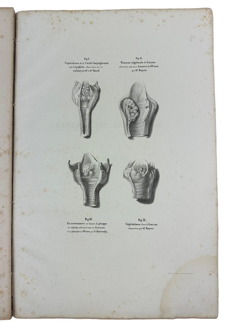 Musee d'anatomie de la faculte de medecine de Strasbourg : histoire des polypes du larynx — 9